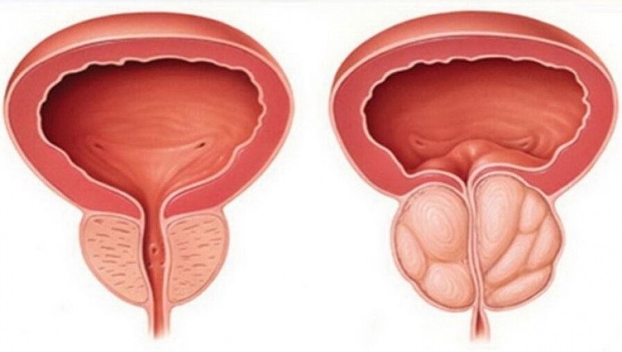 healthy, inflamed prostate with prostatitis