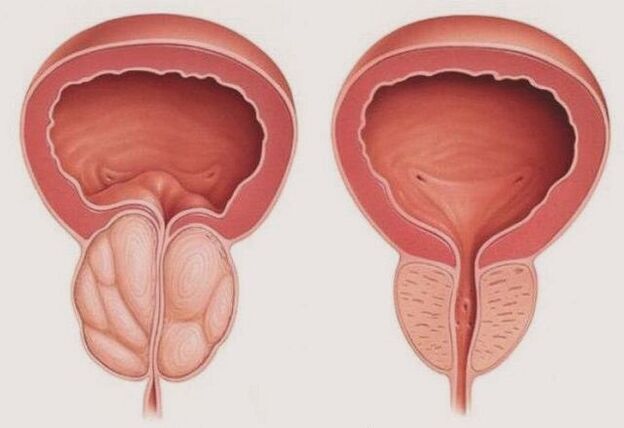 healthy, inflamed prostate with prostatitis