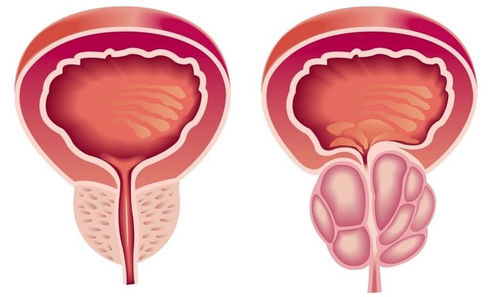 healthy and sick prostate