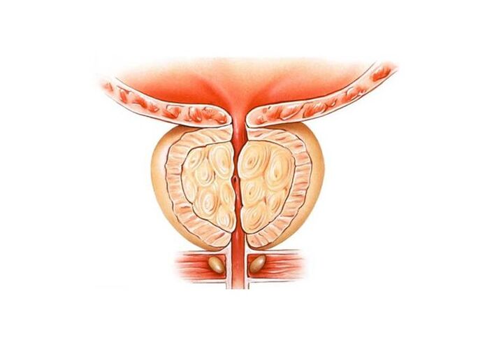 prostate inflammation