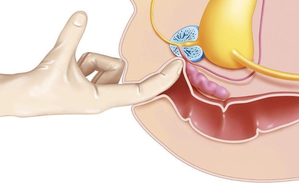 prostate massage for prostatitis treatment